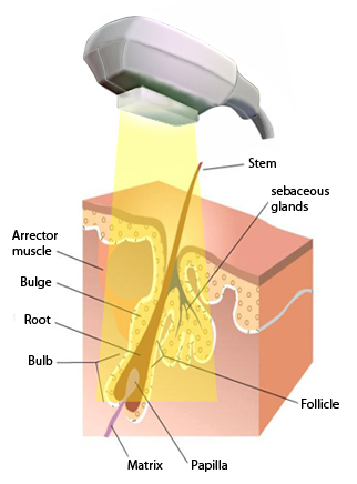 schema-hair-removal